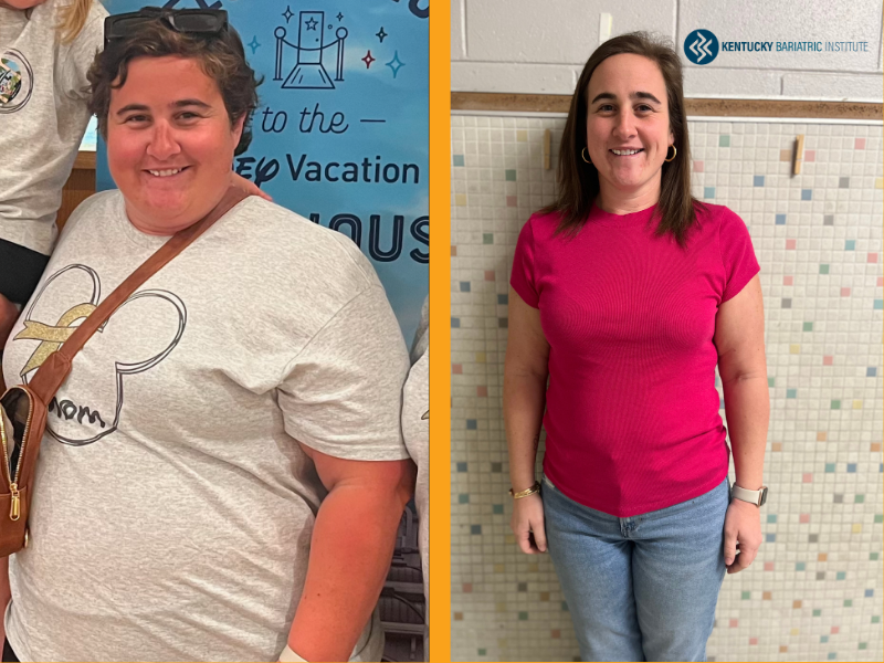 Hilary before and after Kentucky Bariatric Institute