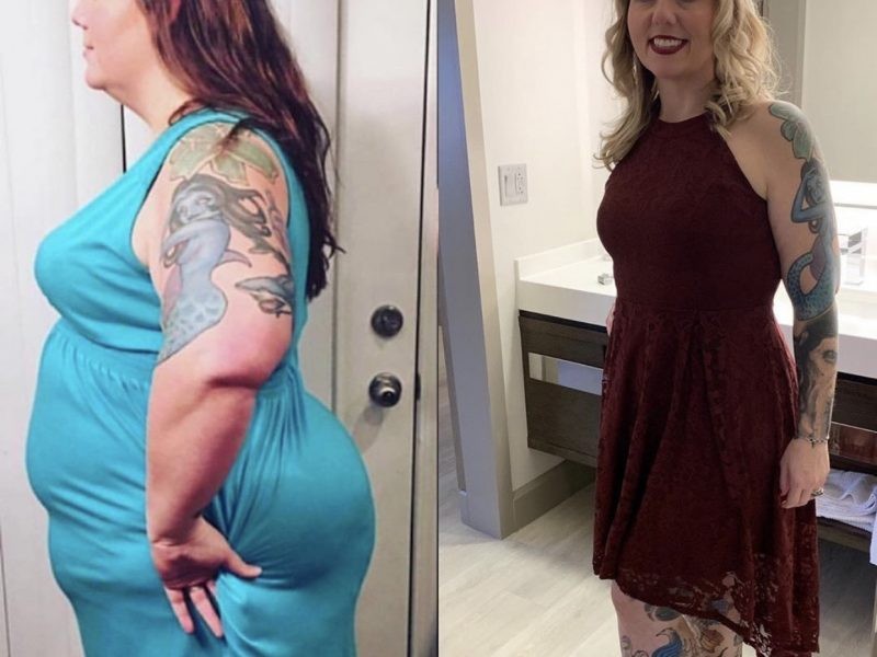 Patient before and after Kentucky Bariatric Institute