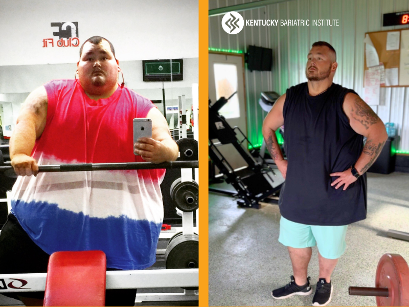 James before and after Kentucky Bariatric Institute