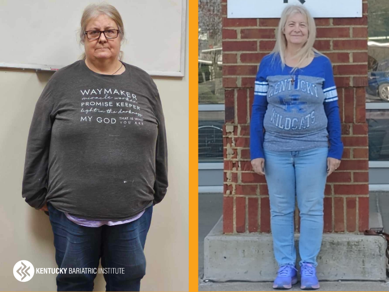 Lisa before and after Kentucky Bariatric Institute